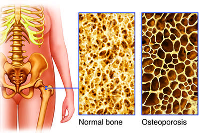 Osteoparosis